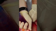 #просмп #перваяпомощь #тампонада раны тампоном.