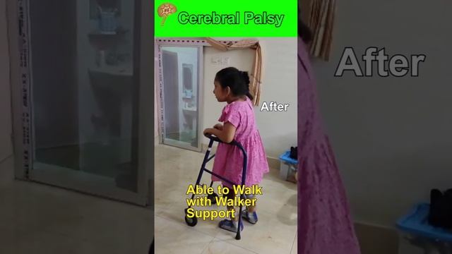 Revolutionary Cell Therapy from Bangladesh Cerebral Palsy Diagnosis Walking with Walker Support