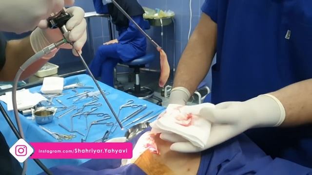 Huge Nasal Polyps Removal By Dr. Shahriyar Yahyavi