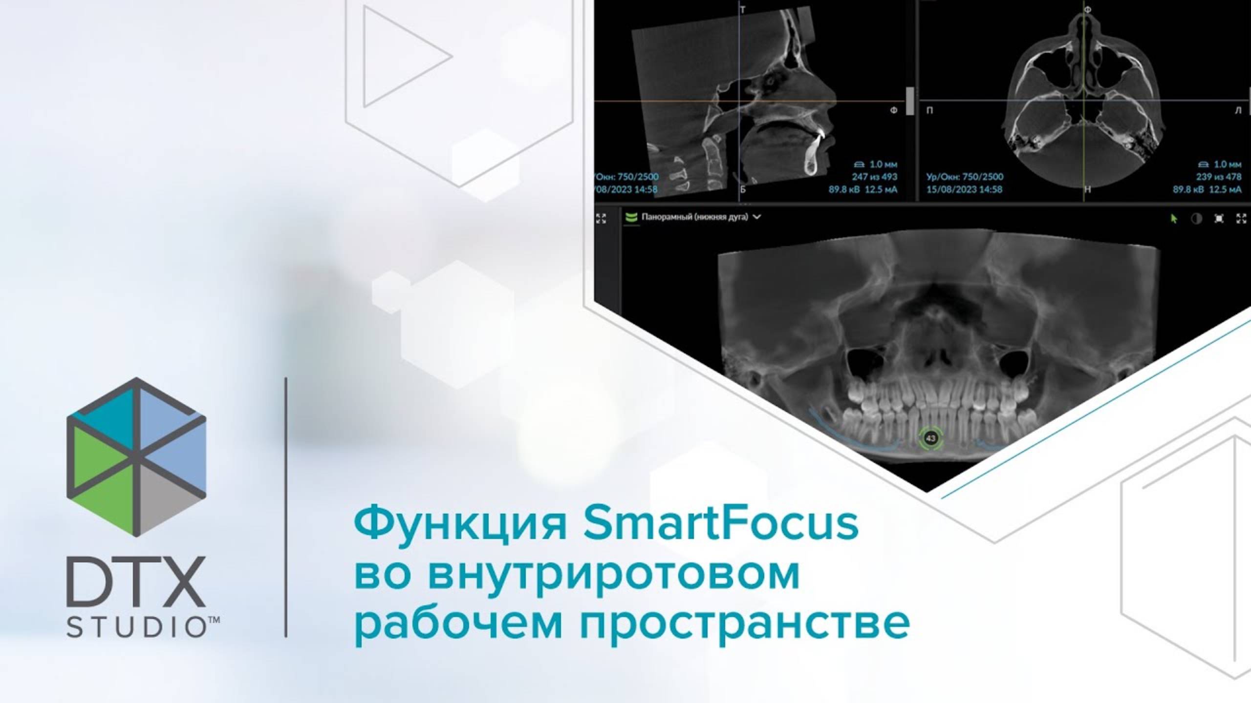 Функция SmartFocus во внутриротовом рабочем пространстве | DTX Studio Clinic