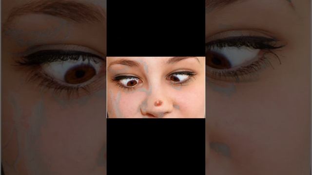 прыщи, как знаковая система тела