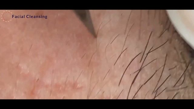 #8 Blackhead Removal / Удаление черных точек