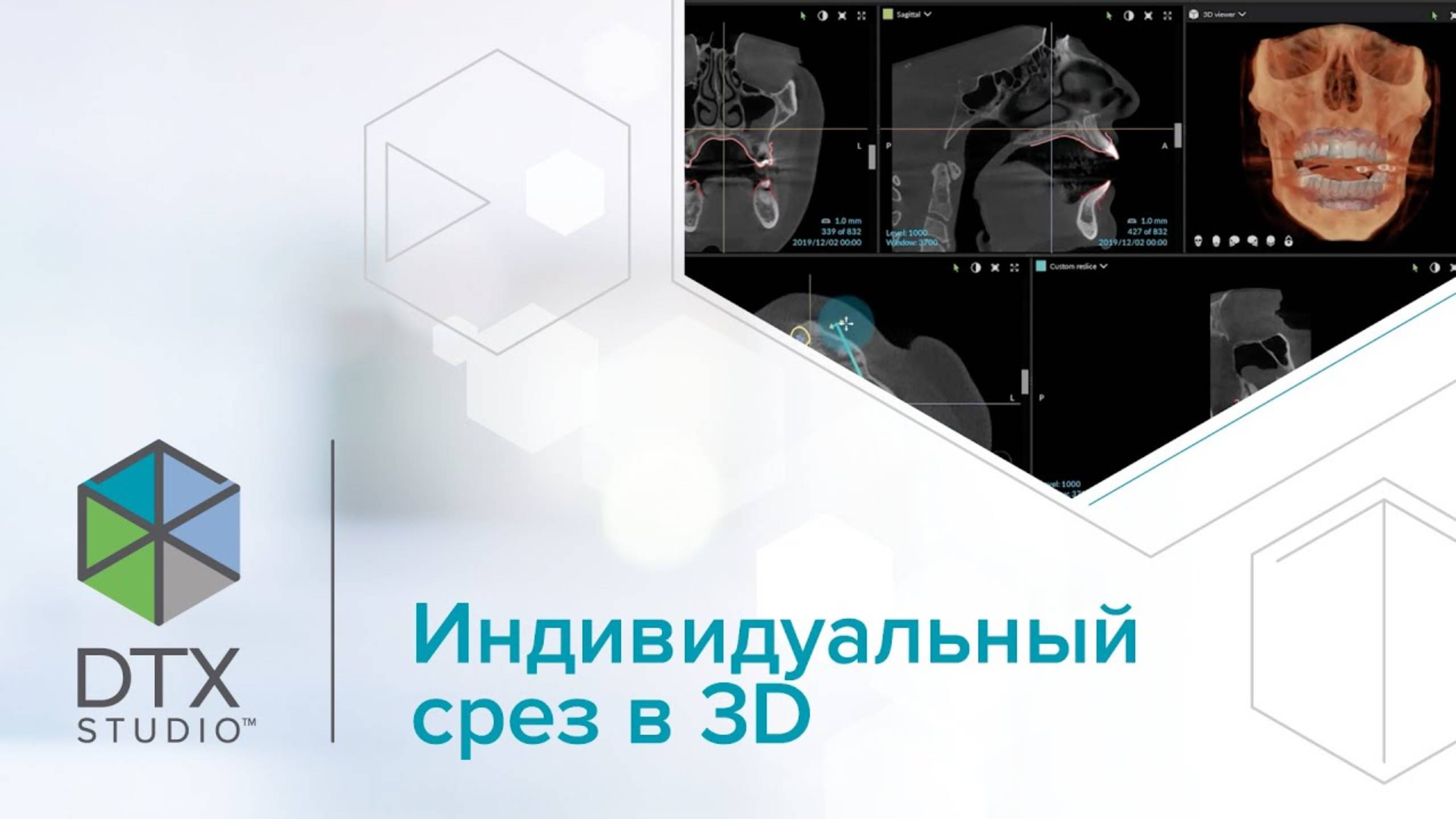 Индивидуальный срез в 3D | DTX Studio Clinic