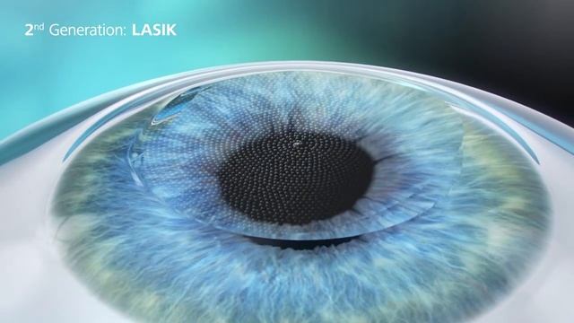 LASERSIGHT: The latest SMILE technology from Zeiss