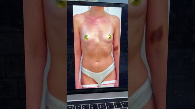 Увеличение груди ментор анатомические 350 см3