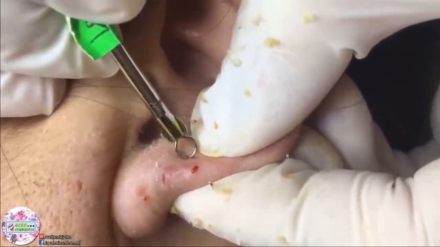 УГРИ   ПРЫЩИ НА ЛИЦЕ! ДАВЛЮ Как избавиться от черноголовых ! How to get rid of blackheads1