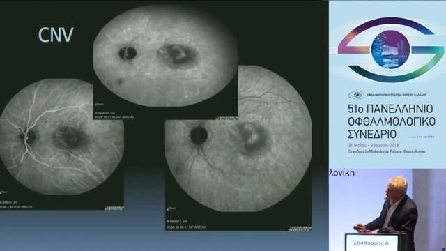 Σουσούρας Θ. - Χρόνια κεντρική ορώδης χοριοαμφιβληστροειδοπάθεια & χοριοειδική νεοαγγείωση