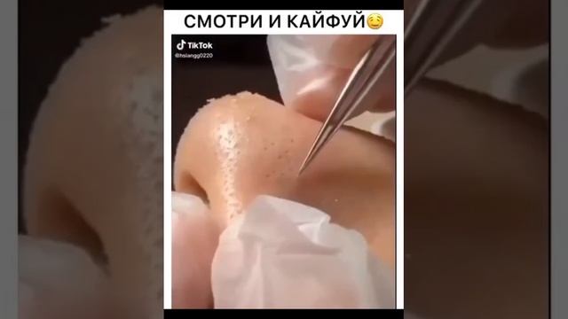 Смотри и кайфуй. Балдёж. Удаление угрей