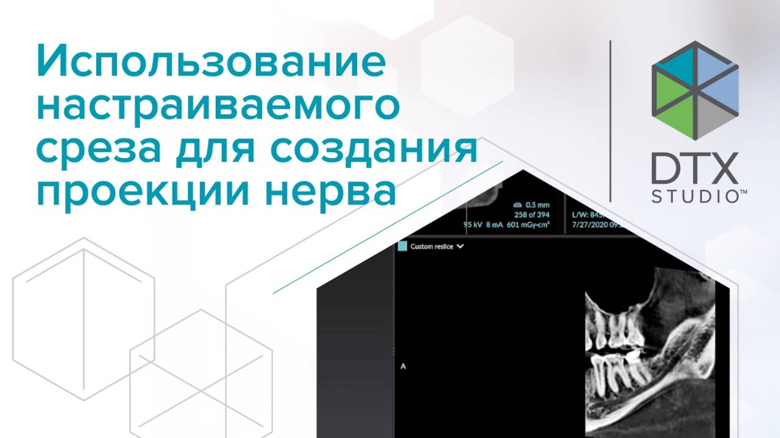 Использование настраиваемого среза для создания проекции нерва | DTX Studio Clinic