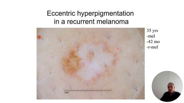 Эпизод 8 – Рецидивирующий невус  vs. меланома