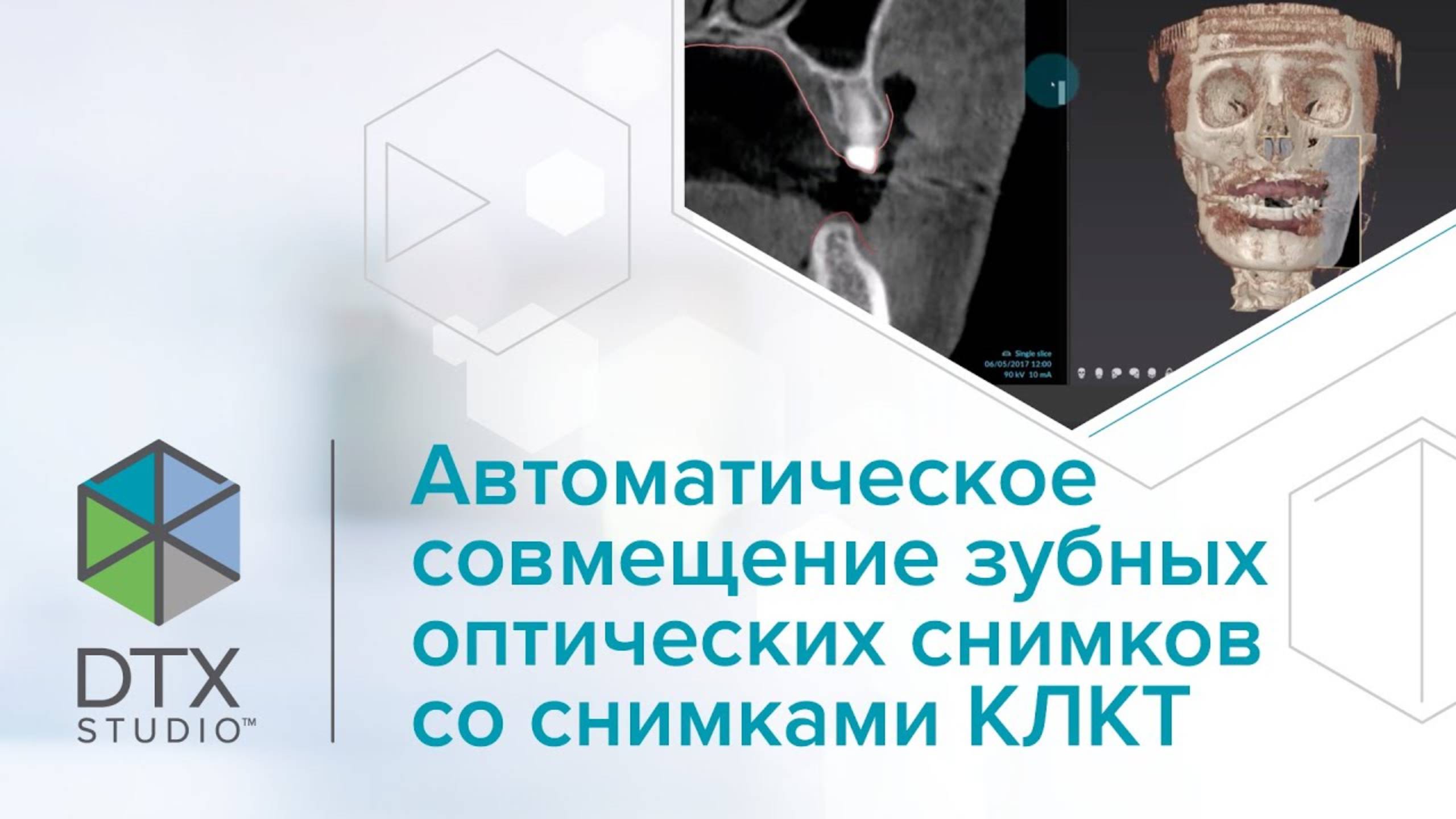 Автоматическое совмещение зубных оптических снимков со снимками КЛКТ | DTX Studio Clinic