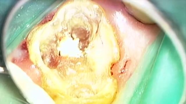 Perforation Repair : OPMI Pico, OrthoMTA