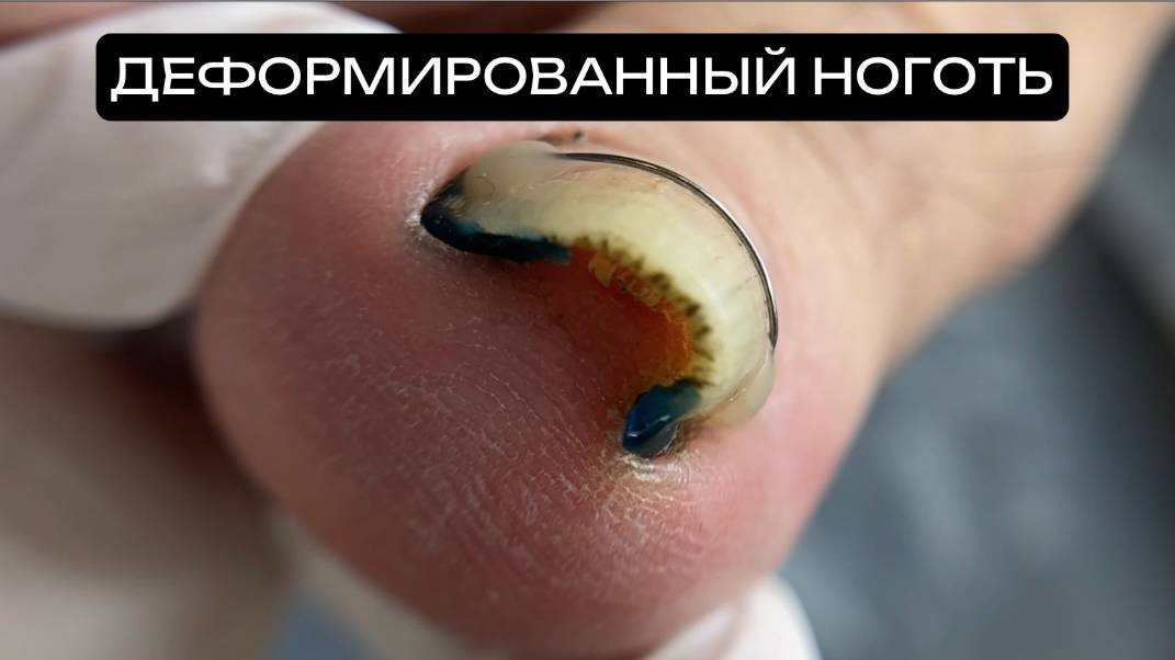 Установака титановой нити на деформированный ноготь