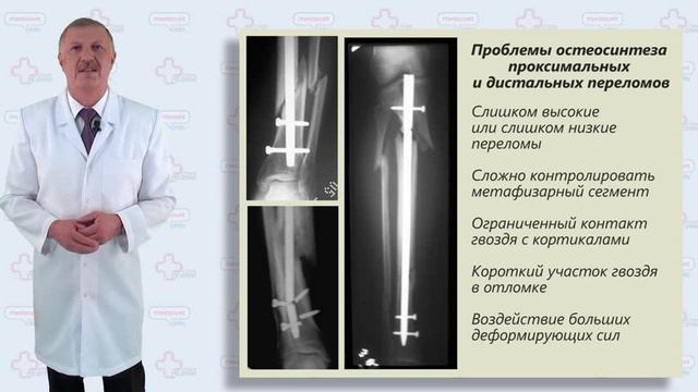 Перелом диафиза большеберцовой кости