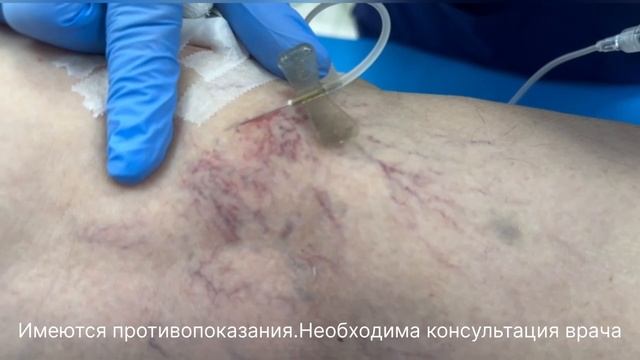 Процедура склеротерапии в клинике «Флеболог.