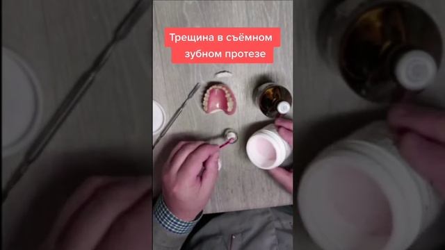 Трещина в съёмном зубном протезе