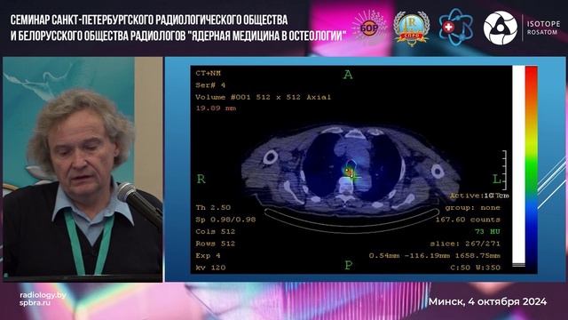 Первый опыт применения на базе 5-й городской клинический б-цы Минска ОФЭКТ/КТ с Tc-99m-HYNIC-PSM