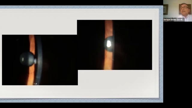 Glaucoma Congénito | Webinar | #OftalmoCórdoba 2020