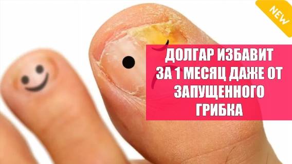 Чем полечить грибок на ногтях ног ⚫