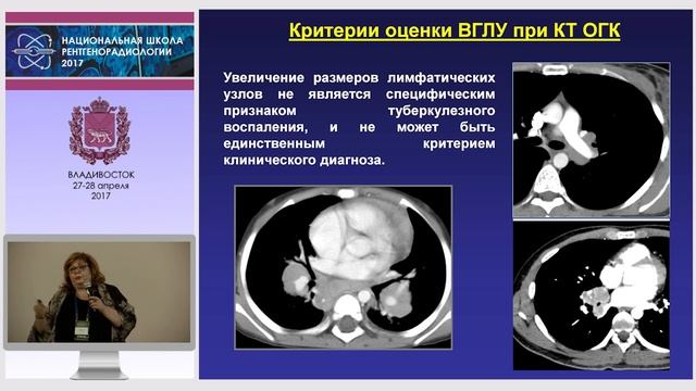 И.А. Соколина - Граница нормы и патологии органов грудной клетки у детей при КТ (1)