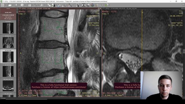 КАК ПРАВИЛЬНО ЧИТАТЬ МРТ ПОЗВОНОЧНИКА. Мастер класс для пациентов от невролога. Резорбция L3-L4.