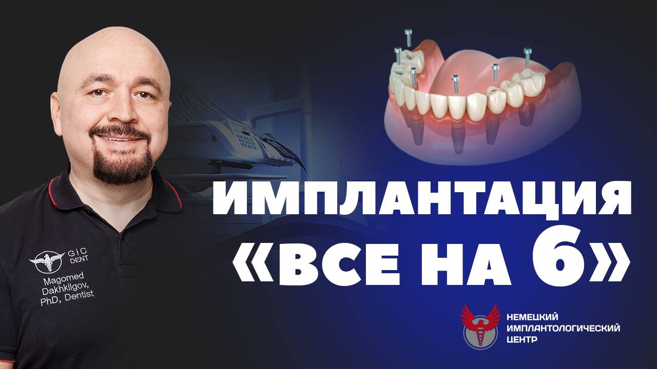 ВСЕ НА 6  или ALL ON 6 - мнение эксперта с 27-летним опытом в имплантации