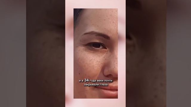 Убираем нависшие веки