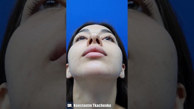 Отдалённый результат ринопластики. 1 год после операции.