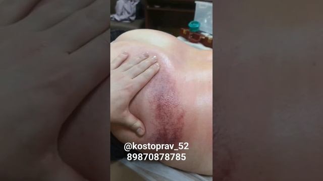 #костоправ #нижнийновгород #боли #грыжа #банки