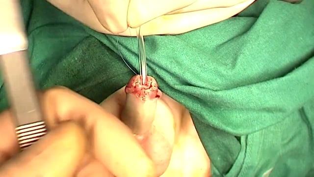 Coronal Hypospadias TIP repair