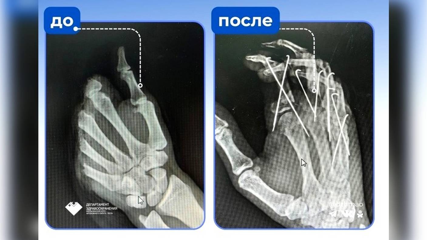 Врачи сургутской травмы восстановили пациенту ампутированные пальцы