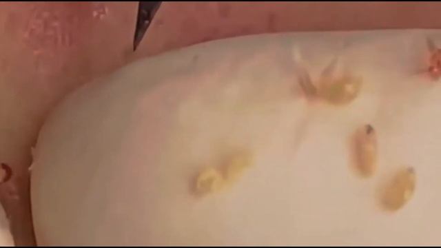 Выдавливание жировиков и прыщей на лице.