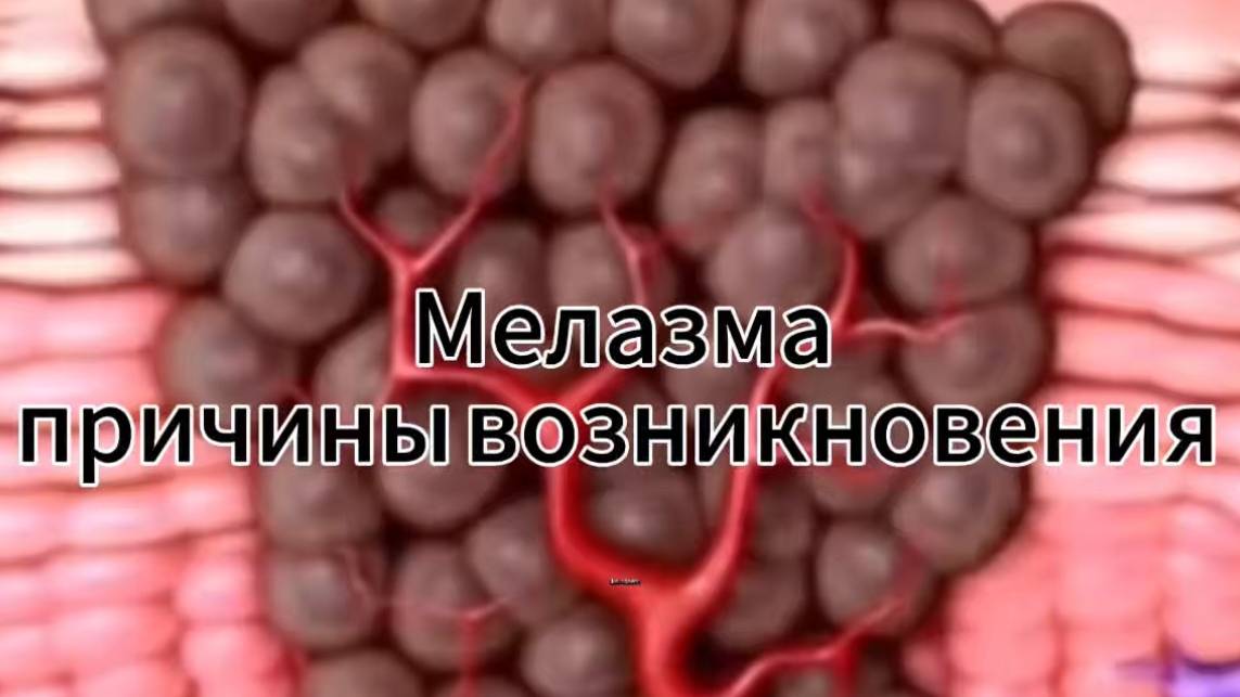 Мелазма. Причины возникновения