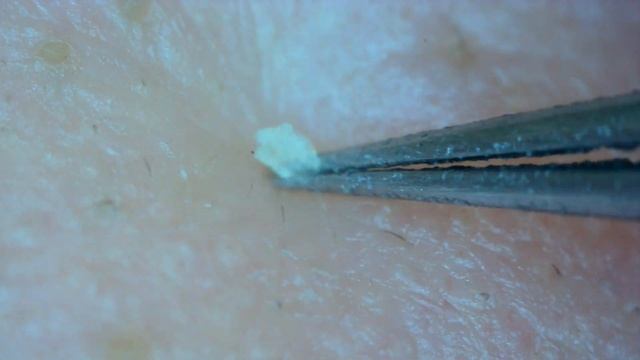 0223 keratin plug removal nose