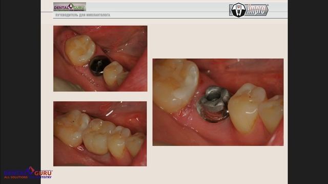 18. 2017 06 27  Особенности выбора абатмента.  Цементная фиксация vs Винтовая.