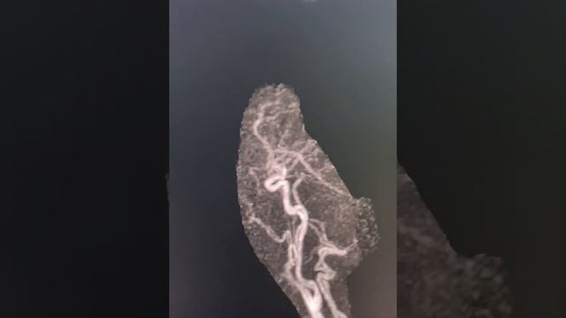 MRI TWIST BRAIN(Time-resolved angiography With Interleaved Stochastic Trajectories)MRA& MRV Contras