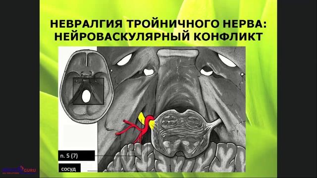 04. 2018 02 06  НИКОЛАЕВА А    Нейростоматологические заболевания вызванные герпесвирусными инфекция