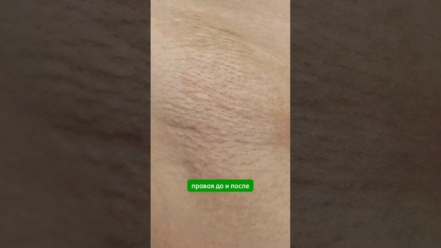 Запись на электроэпиляцию через wa 79688033388 #электроэпиляциямосква #электроэпиляция