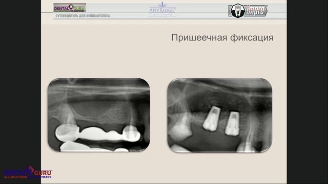 25. 15.08.2017 Одномоментная имплантация - от одиночной коронки до тотальной реабилитации.