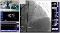 IVUS Guided PCI of LAD/D1 Bifurcation using DK Crush Technique