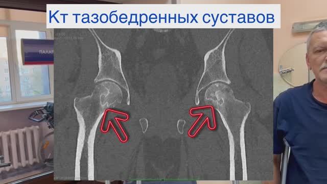 Эндопротезирование тазобедренного сустава | Отзывы пациентов после операции