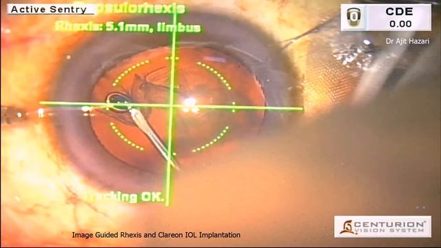 Image Guided Rhexis and Clareon IOL implantation