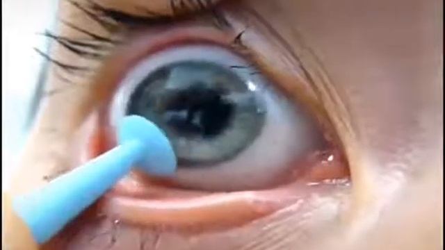Contact lens