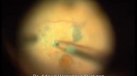 Sd traccional macular en retinopatía diabética