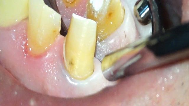 Препарирование зуба под микроскопом  Tooth preparation under microscope