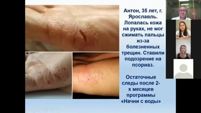 Результаты на марафоне. Псориаз, лопалась кожа на руках и ногах, боли