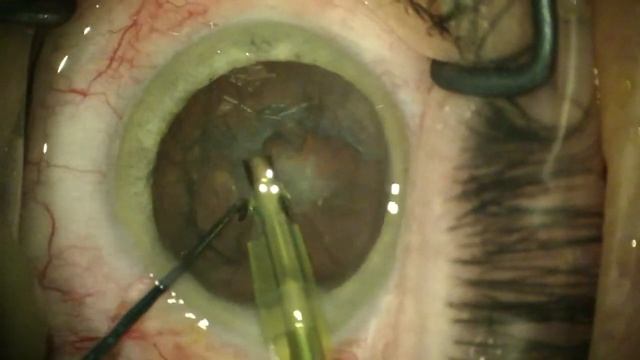 Multifocal lens implantation after cataract surgery