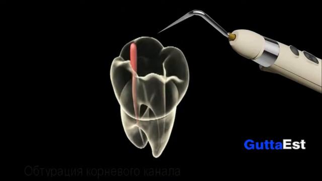 Обтурация корневых каналов