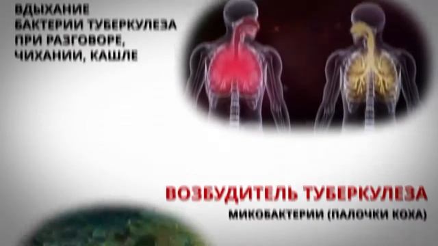 Туберкулез