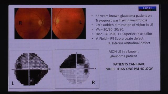 AIOC2020 IC422 T5 Dr Sumita Mohapatra Perimetry misinterpretation   Tips to differentiate glaucomat